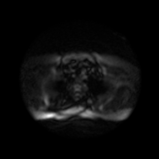 Medical Image Segmentation: GI Tract